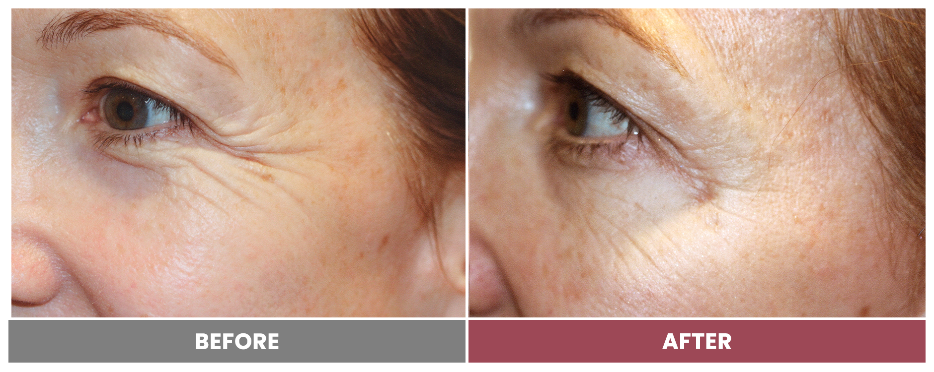 BOTOX FOR WRINKLES & BROW LIFT - Case 6